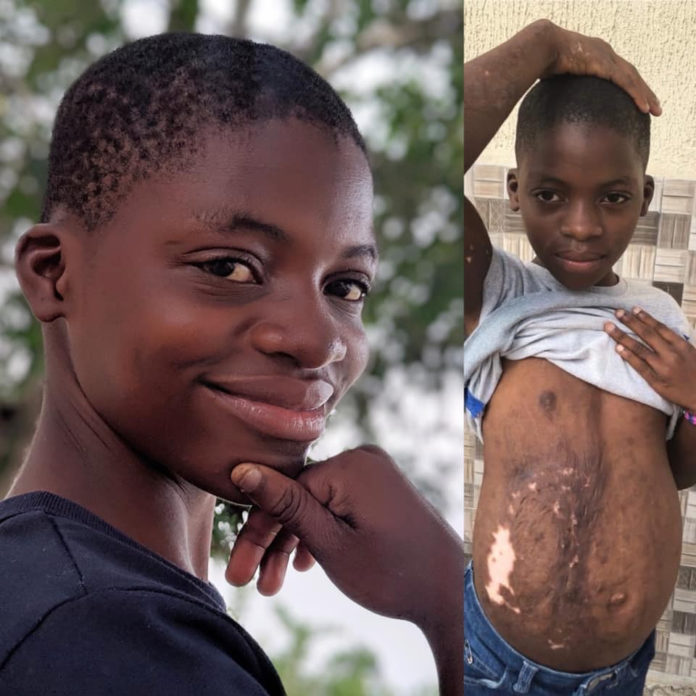 Incroyable transformation d'une jeune fille 3 ans après avoir été accusée de sorcellerie et incendiée à Akwa Ibom
