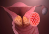 Cancer du col de l’utérus : 14 cas suspects détectés à kaffrine