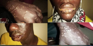 Dermatoses chez des pêcheurs: les détails du rapport d'investigation