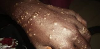 Maladie dermatologique : la marine mène des investigations en haute mer